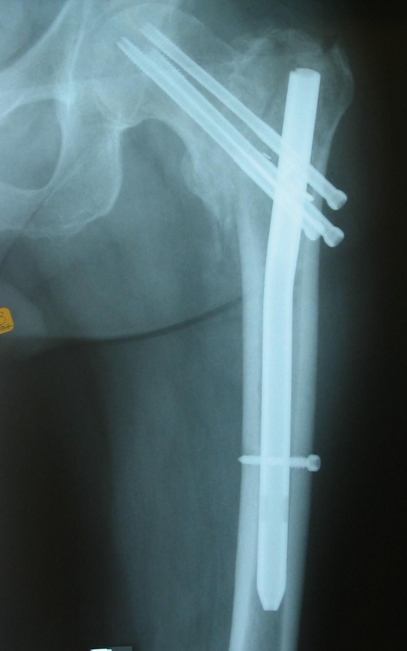 intramedullary nail
